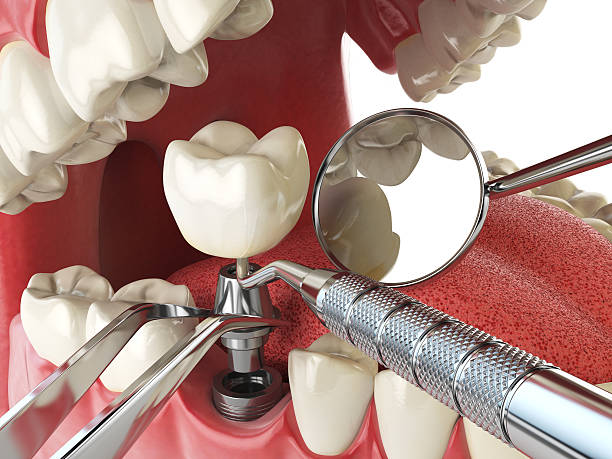 Best Emergency Wisdom Tooth Extraction in Fitchburg, MA